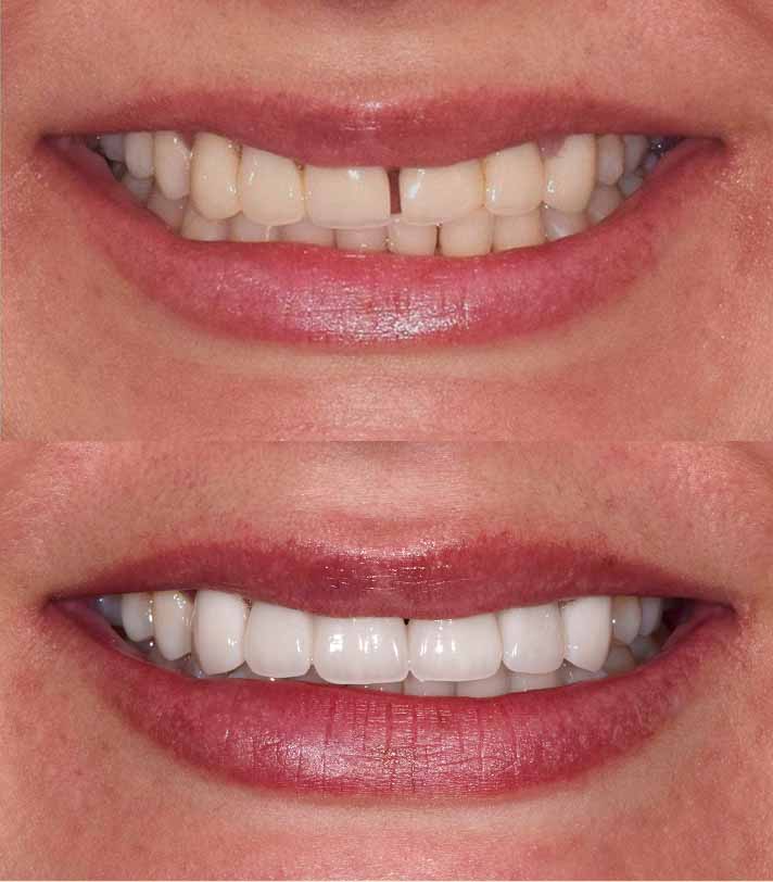 results of dental services from Broadwing Dental Studio