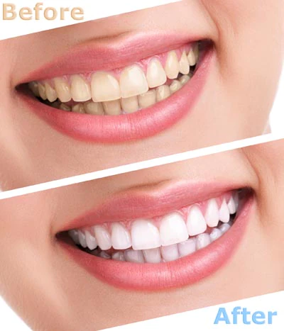 teeth whitening New Rochelle, NY