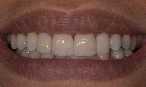 After image