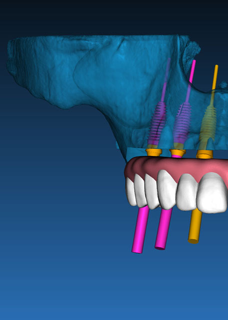 all-on-X implants at Broadwing Dental Studio