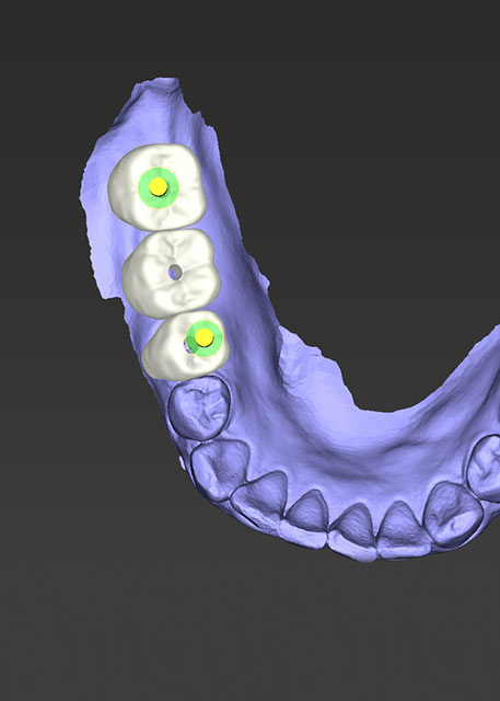 dental implants offered at Broadwing Dental Studio