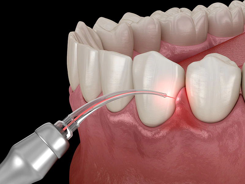 Dental laser treating gum tissue between lower teeth